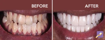 New Image Dental Patient photo of before and after. Dentist in Inglewood, CA