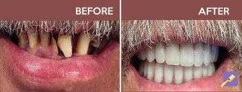 New Image Dental Patient photo of before and after. Dentist in Inglewood, CA