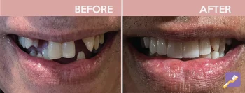 New Image Dental Patient photo of before and after. Dentist in Inglewood, CA