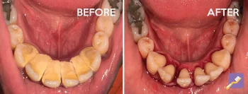 New Image Dental Patient photo of before and after. Dentist in Inglewood, CA