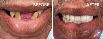 New Image Dental Patient photo of before and after. Dentist in Inglewood, CA