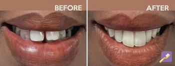 New Image Dental Patient photo of before and after. Dentist in Inglewood, CA