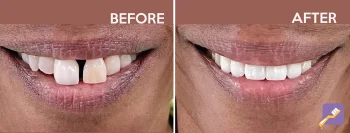 New Image Dental Patient photo of before and after. Dentist in Inglewood, CA