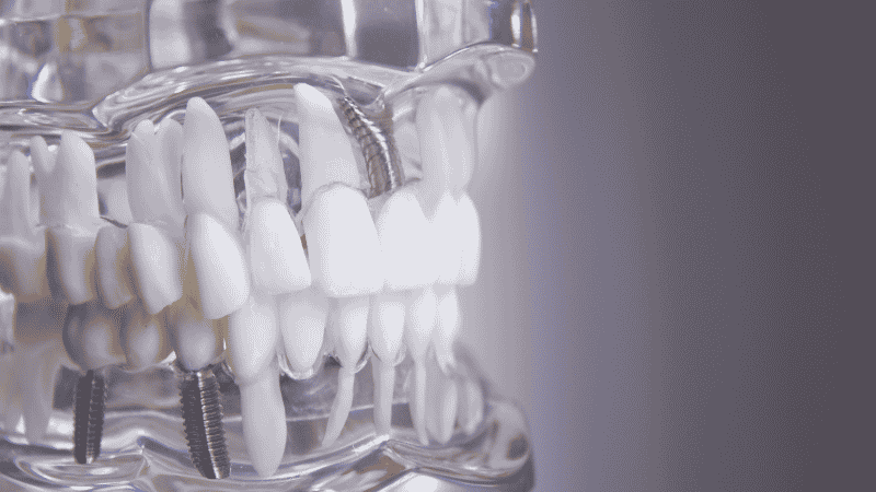 All on 4 vs single implants