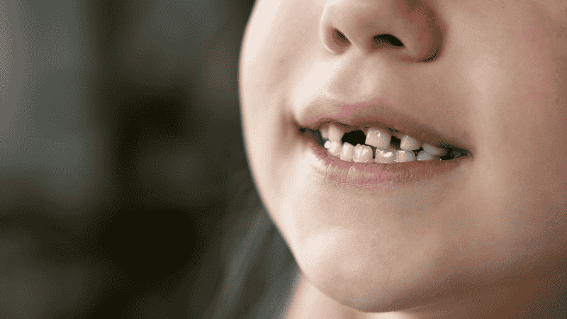 Consequences of missing teeth