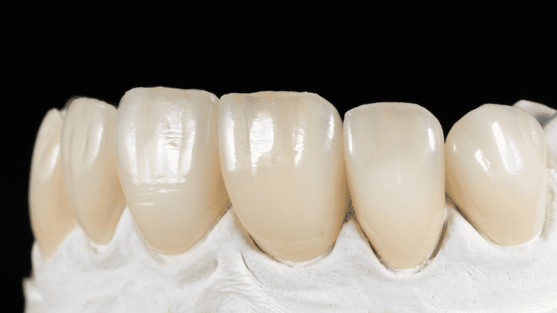 why do my veneers look fake
